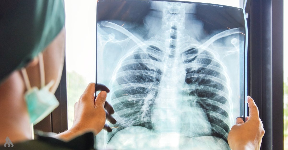 رێکخراوی تەندروستی هۆشداریی دەدات لە بڵاوبونەوەی نەخۆشی سیل